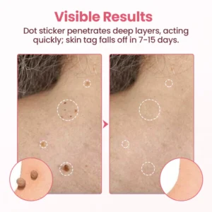 Biancat® Painless Micro Wart Removal Patch image Biancat® Painless Micro Wart Removal Patch