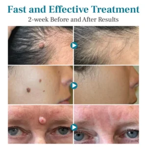 Slimoly™ LumeSkin Mole and Wart Removal Laser Pen