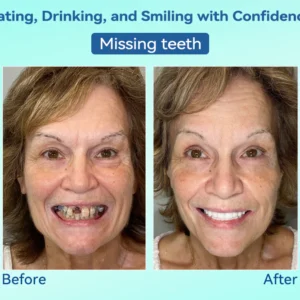 DIYSTAR™ Premium Denture image DIYSTAR™ Premium Denture