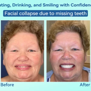 DIYSTAR™ Premium Denture image DIYSTAR™ Premium Denture