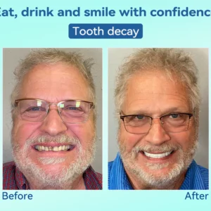 DIYSTAR™ Premium Denture image DIYSTAR™ Premium Denture