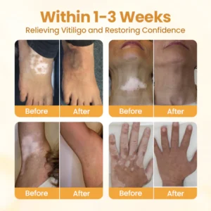 BBOJI™ VitiClear Pro Bee Toxin Cream