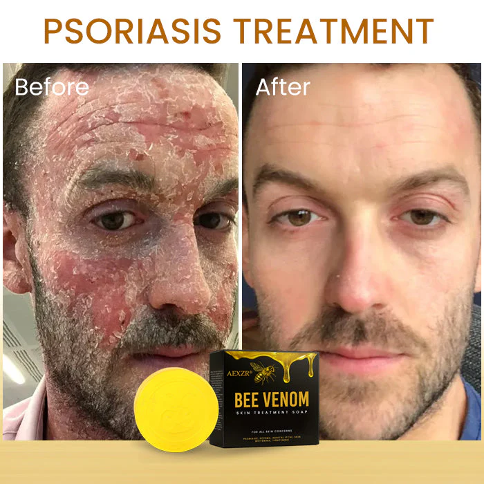 AEXZR® Bee Venom Skin Treatment Soap image AEXZR® Bee Venom Skin Treatment Soap