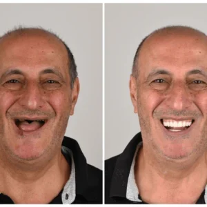 NESLEMY™ Custom-Fit Functional Dentures