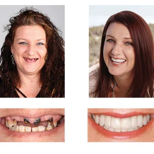 NESLEMY™ Custom-Fit Functional Dentures