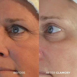 Glamory MicroLift System