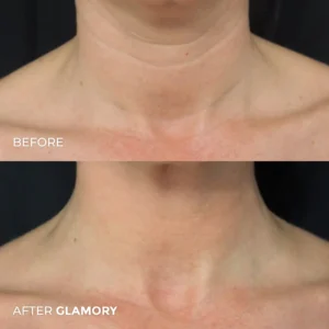Glamory MicroLift System