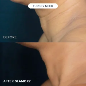Glamory MicroLift System