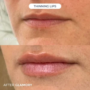 Glamory MicroLift System