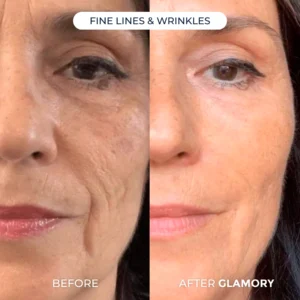 Glamory MicroLift System-Erase Years of Aging at Home in Just 5 Minutes