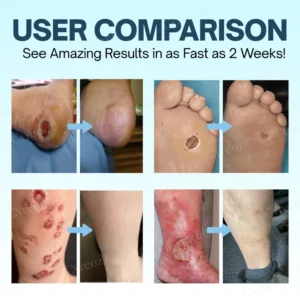 Cvreoz® Diabetes Treatment Cream