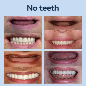 YUNPSO™– Premium Adaptive Dentures