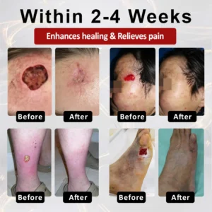 CVREOZ® DiaCure Bee Venom & Centella Diabetic Foot Ulcer Spray image CVREOZ® DiaCure Bee Venom & Centella CVREOZ® DiaCure Bee Venom & Centella Diabetic Foot Ulcer SprayDiabetic Foot Ulcer Spray