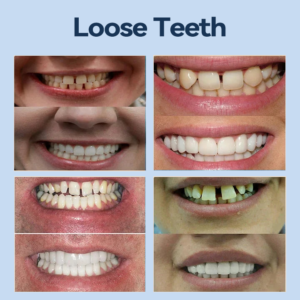 YUNPSO™– Premium Adaptive Dentures