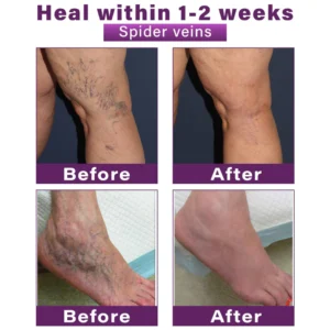 CVREOZ® Polidocanol Nano Varicose Vein Patch