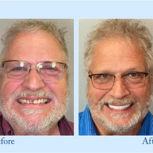 Smileasego™ - Premium Denture
