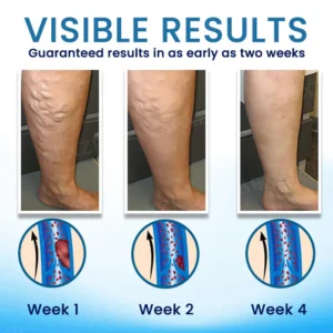Cvreoz® Herbal Varicose Veins Treatment Spray - ✅ Clinically proven to eliminate varicose veins in just 7 days!