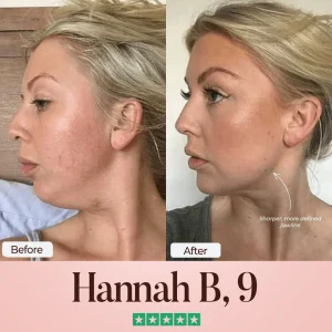 SculptFix™ Jawline Mask