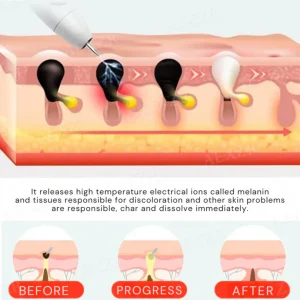 Bikenda® Portable Skin Care Laser Pen image Bikenda® Portable Skin Care Laser Pen