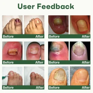 Dobshow® Nail Fungus Renewal Gel image Dobshow® Nail Fungus Renewal Gel