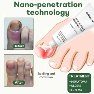 Dobshow® Nail Fungus Renewal Gel image Dobshow® Nail Fungus Renewal Gel