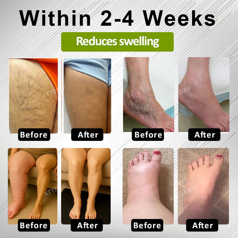 ATTDX® Fluid Regulation Edema Care Cream image ATTDX® Fluid Regulation Edema Care Cream