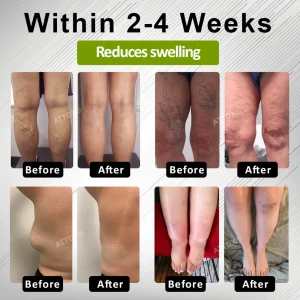 ATTDX® Fluid Regulation Edema Care Cream image ATTDX® Fluid Regulation Edema Care Cream