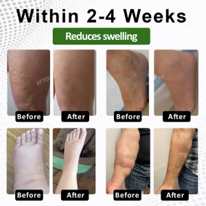 ATTDX® FluidiQ Edema Support Spray image ATTDX® FluidiQ Edema Support Spray