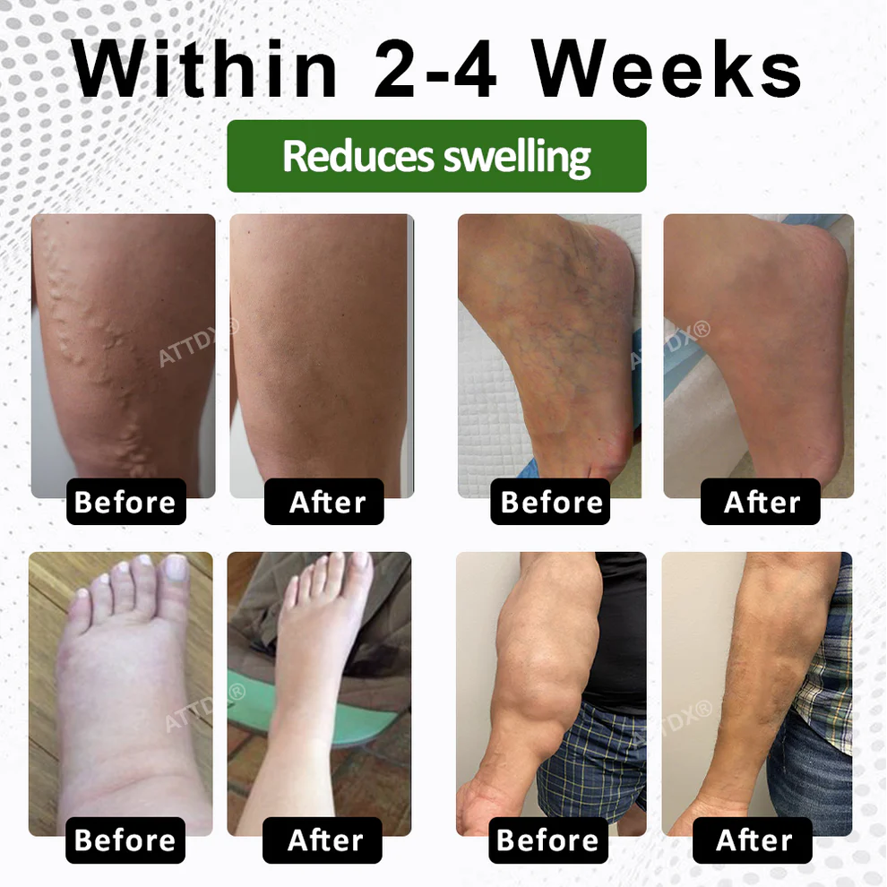 ATTDX® FluidiQ Edema Support Spray image ATTDX® FluidiQ Edema Support Spray