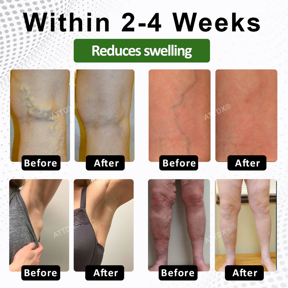 ATTDX® FluidiQ Edema Support Spray image ATTDX® FluidiQ Edema Support Spray