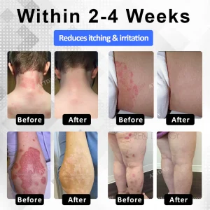 ATTDX® PsoriEase Magnesium Healing Foam image ATTDX® PsoriEase Magnesium Healing Foam