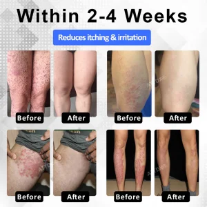 ATTDX® PsoriEase Magnesium Healing Foam image ATTDX® PsoriEase Magnesium Healing Foam