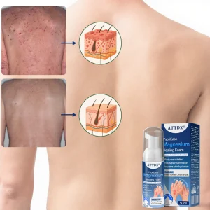 ATTDX® PsoriEase Magnesium Healing Foam image ATTDX® PsoriEase Magnesium Healing Foam