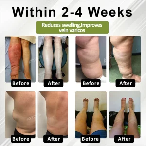 Oveallgo® VeinoRoll Therapy Edema Comfort Cream image Oveallgo® VeinoRoll Therapy Edema Comfort Cream