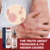 ATTDX® DermSoothe Psoriasis Relief Spray image ATTDX® DermSoothe Psoriasis Relief Spray