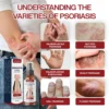 ATTDX® DermSoothe Psoriasis Relief Spray image ATTDX® DermSoothe Psoriasis Relief Spray