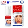 Croaie® Vitiligo Treatment Spray - No allergies image Croaie® Vitiligo Treatment Spray - No allergies