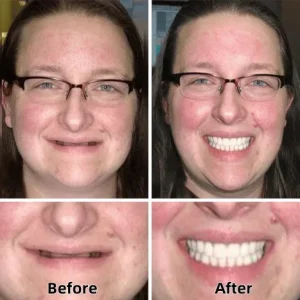 Yagoo™-Custom-Fit Full Functional Dentures